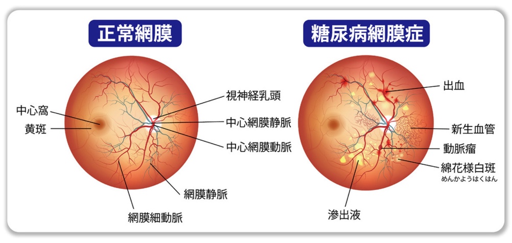 糖尿病網膜症を予防するにはどのような方法がありますか?