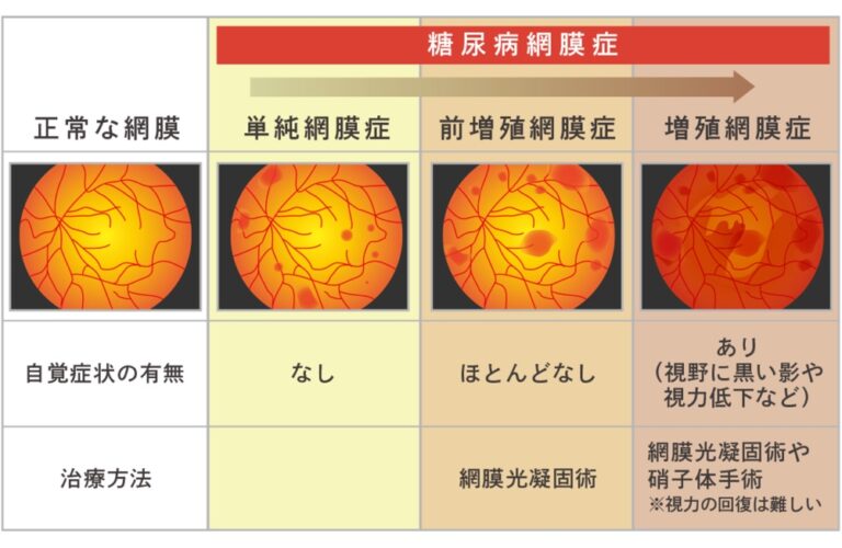 糖尿病網膜症の症状は何ですか?